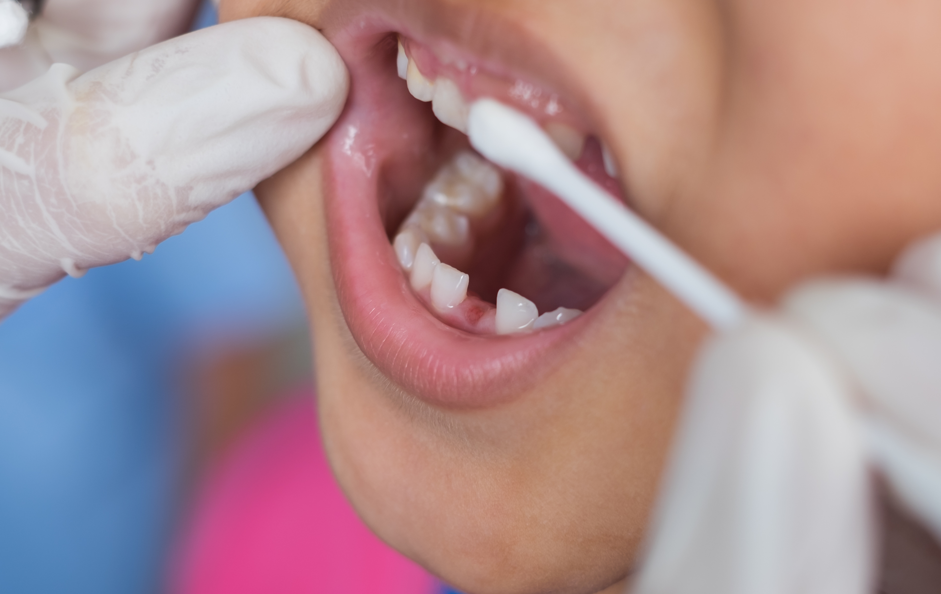 Dental Sealants and Fluoride Varnish